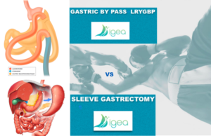 sleeve versus gastric by pass comparison