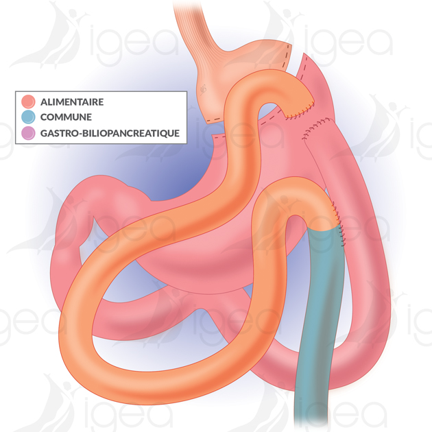 anneau gastrique gastric banding bendaggio gastrico