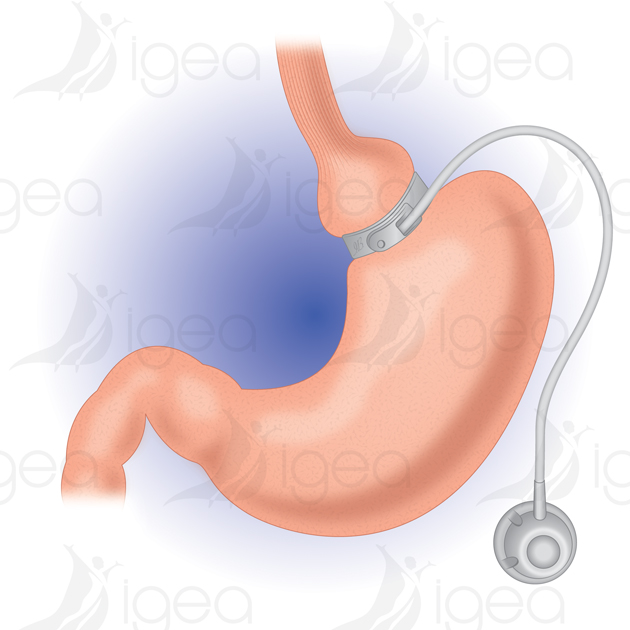 anneau gastrique gastric banding bendaggio gastrico